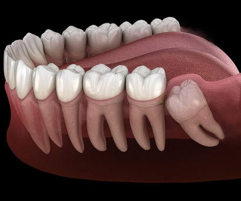 جراحی دندان عقل؛ مراحل درمان و مراقبت های بعد از آن