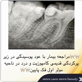 درمان ریشه دندان بیماری دیگر