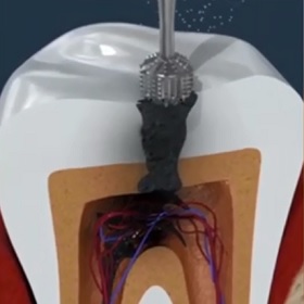نمایش تصویری انجام درمان ریشه دندان
