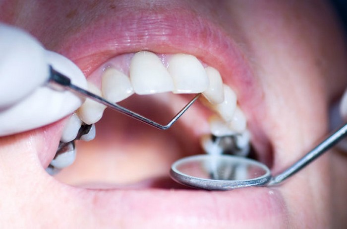 موارد منع استفاده از آمالگام برای پرکردن دندان