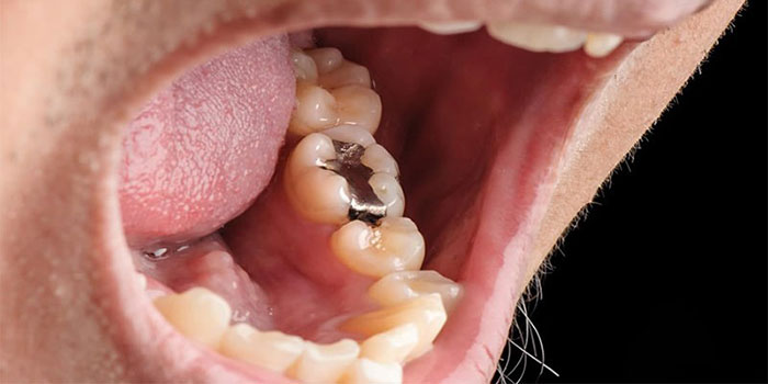 عوارض پر کردن دندان با آمالگام