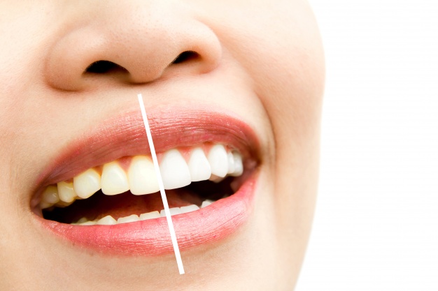 بلیچینگ دندان بهتر است یا ونیر کامپوزیت ؟