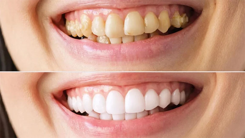 جلوگیری از زرد شدن کامپوزیت های دندان