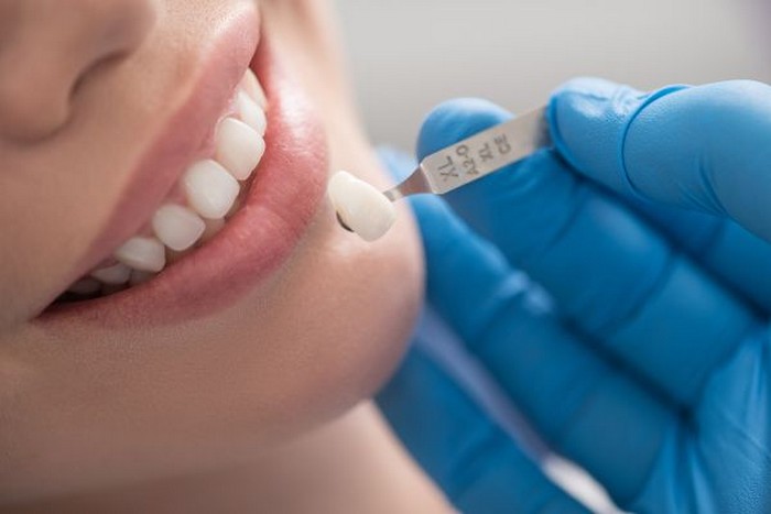 بررسی مزایا و معایب لمینت دندان