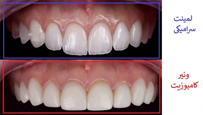 مقایسه موارد توصیه شده برای استفاده از لمینت دندان یا کامپوزیت