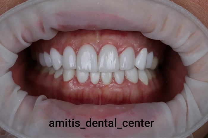 نمونه کار لمینت دندان در کلینیک آمیتیس