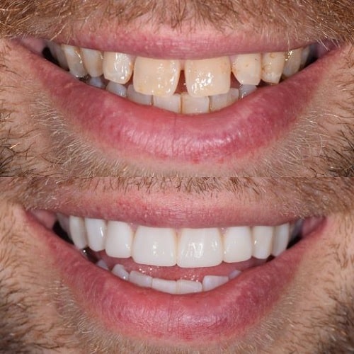 نمونه درمان کامپویت دندان با تراش دندان