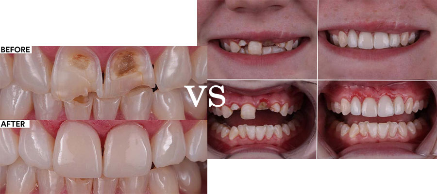 روکش دندان بهتر است یا کامپوزیت دندان،کاربرد هر یک چیست