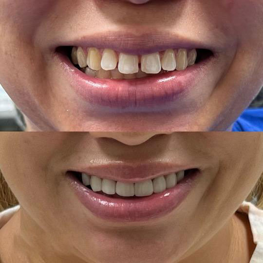 مقایسه کاربرد کامپوزیت دندان با روکش