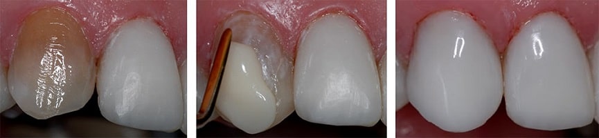 مقدار تراش دندان برای کامپوزیت و دلایل تراشیدن دندان