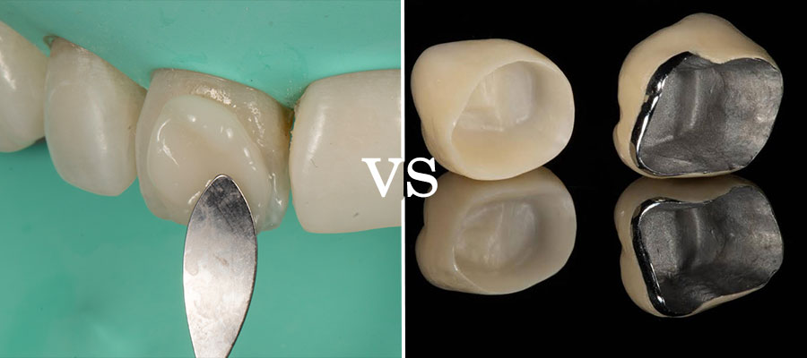 روکش دندان بهتر است یا کامپوزیت دندان