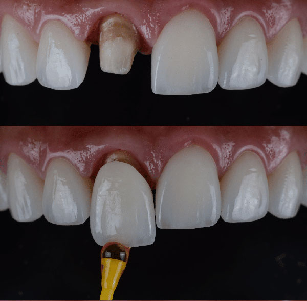 روکش دندان چیست و چه تفاوتی با کامپوزیت دارد