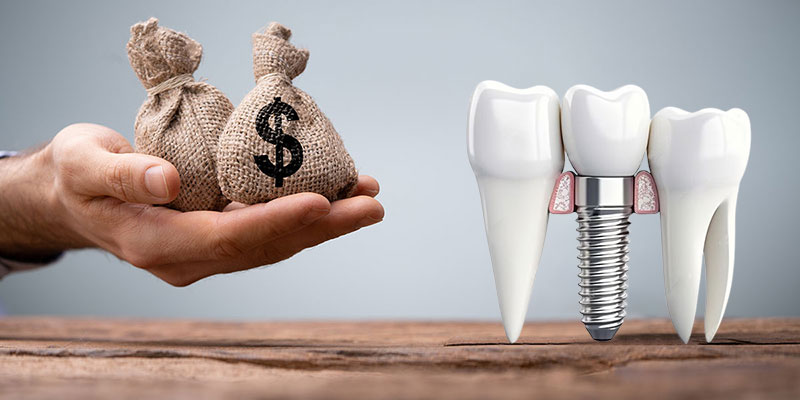 قیمت ایمپلنت دندان 1403