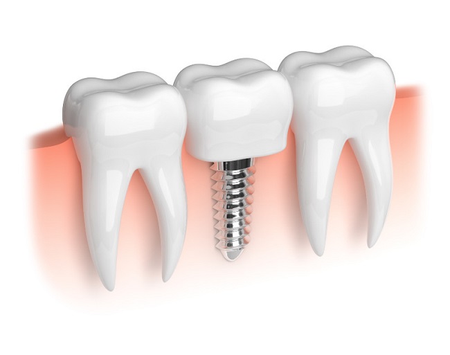 ایمپلنت دندان قبل یا بعد از جراحی بینی