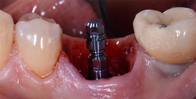 یک ایمپلنت دندانی موفق به چه عواملی بستگی دارد؟