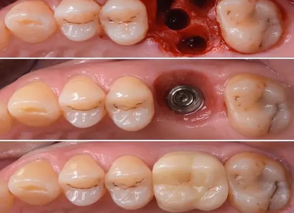 معایب ایمپلنت دندان فوری یا یک روزه چیست؟