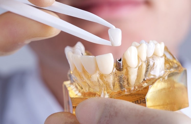 تاثیر نوع روکش بر هزینه ایمپلنت دندان