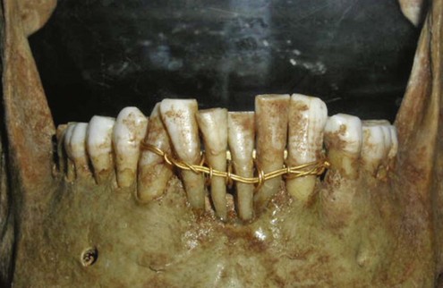تاریخچه ایمپلنت دندان در ایران و جهان