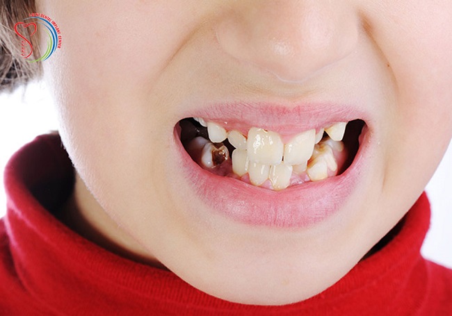 ایمپلنت دندان برای کودکان