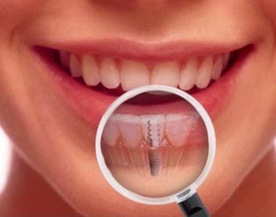عوارض خطرناک ایمپلنت دندان