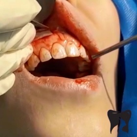 جراحی lip repositioning