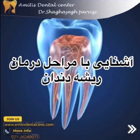 آشنایی با مراحل درمان ریشه دندان