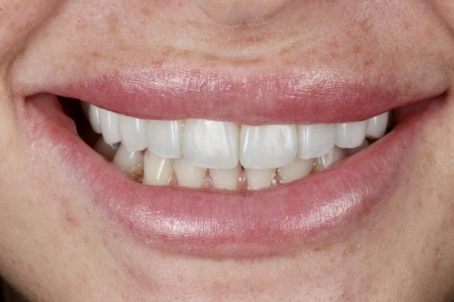 کامپوزیت دندان در پاسداران