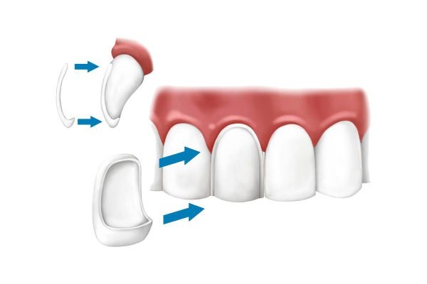 کاربردهای لمینت دندان