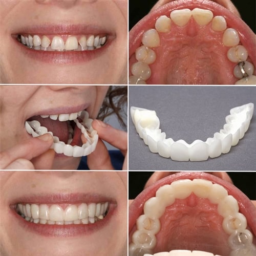 کاربرد کامپوزیت متحرک دندان سرامیکی
