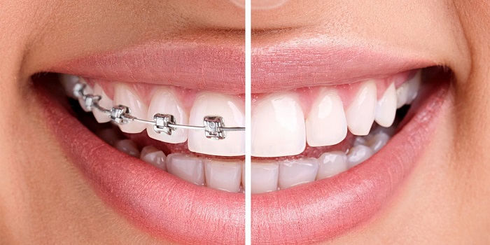 مقایسه لمینت دندان و ارتودنسی