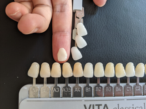 انتخاب رنگ لمینت دندان