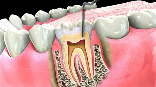 دندان چگونه عصب کشی می شود؟