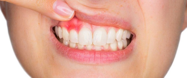 عفونت ایمپلنت دندان و درمان آن