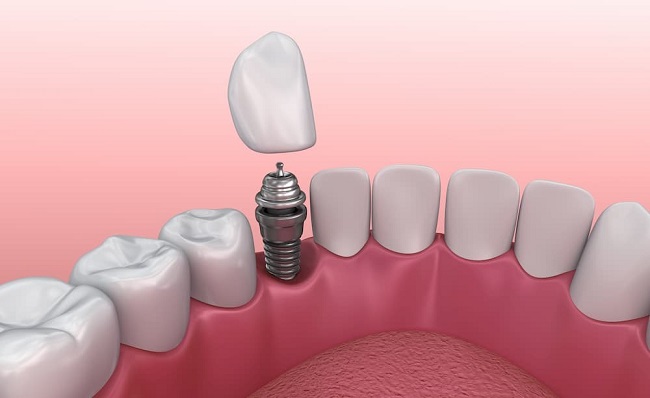 بررسی انواع برندهای ایمپلنت دندان فرانسوی
