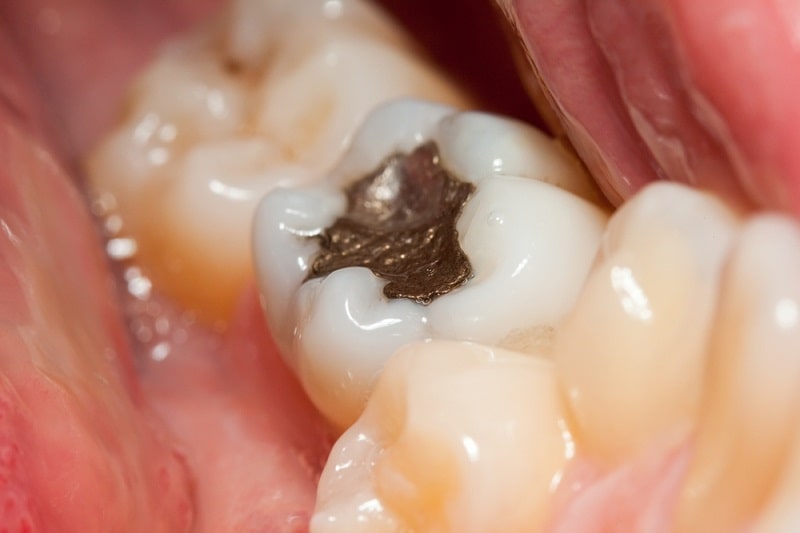 علت درد دندان عصب کشی شده هنگام جویدن