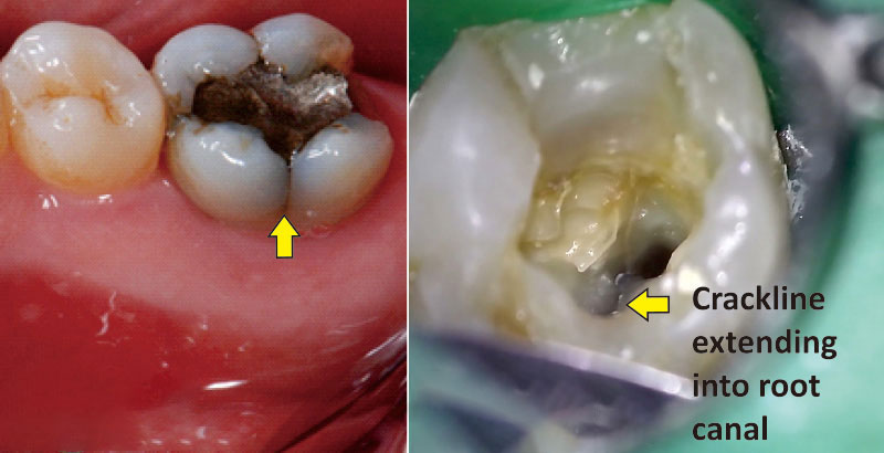 دندان درد بعد از عصب کشی