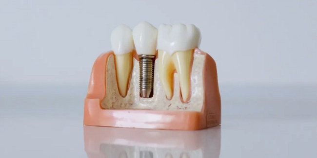 هزینه ایمپلنت دندان با بیمه تکمیلی