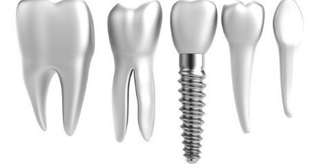 انواع برندهای ایمپلنت دندان سوئیسی