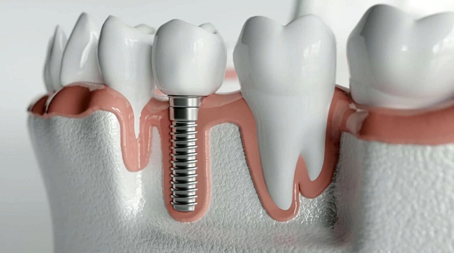 انواع برندهای ایمپلنت دندان سوئیسی