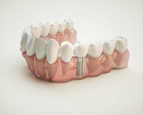 کامپوزیت بهتر است یا ایمپلنت دندان