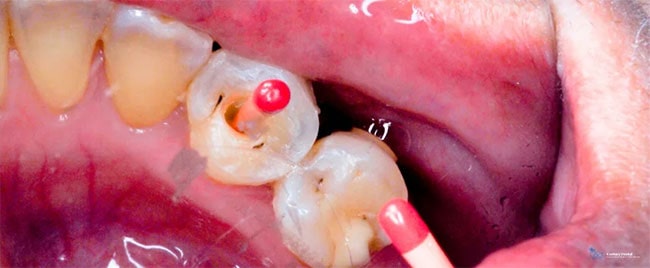 علائم نیاز به عصب کشی دندان