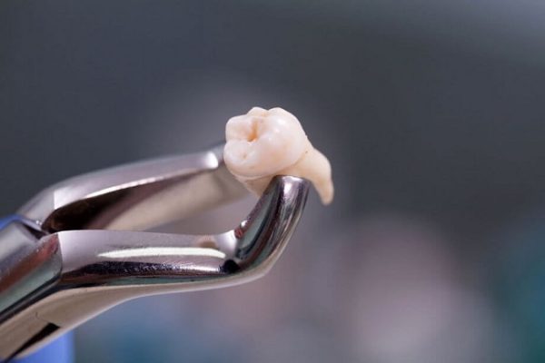 چه موقع دندان عقل نیاز به جراحی دارد؟