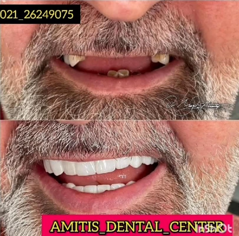 نمونه درمان ایمپلنت دندان در دندانپزشکی آمیتیس