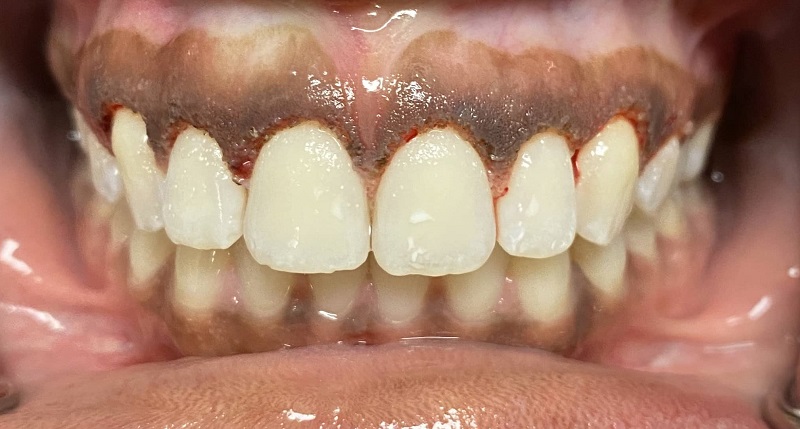 عوارض جراح افزایش طول تاج دندان