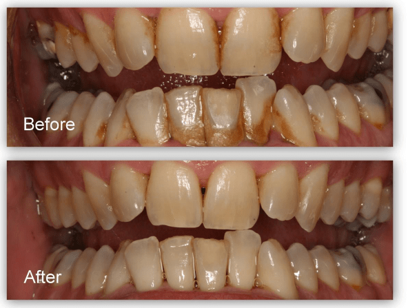 قبل و بعد از جرمگیری دندان