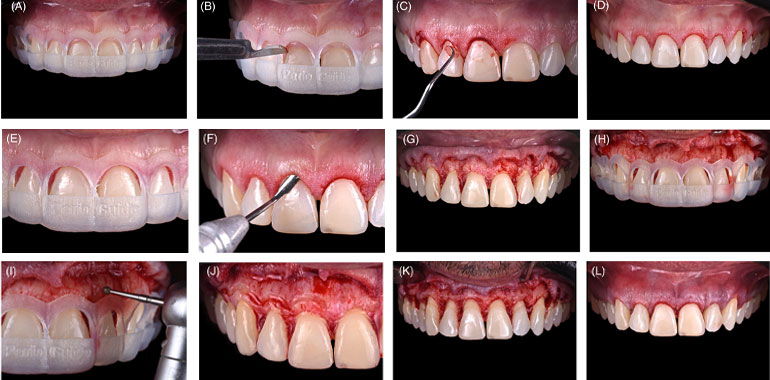 افزایش طول تاج دندان با تیغ جراحی