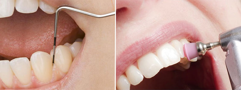 تفاوت بروساژ و جرمگیری دندان