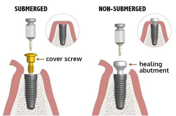 تفاوت ایمپلنت دندان یک مرحله ای و دو مرحله ای