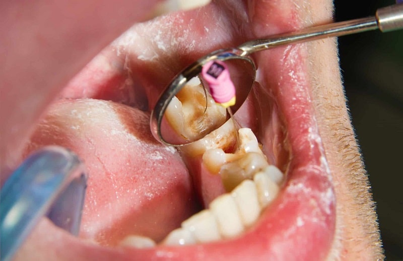 چه زمانی به عصب کشی دندان نیاز است