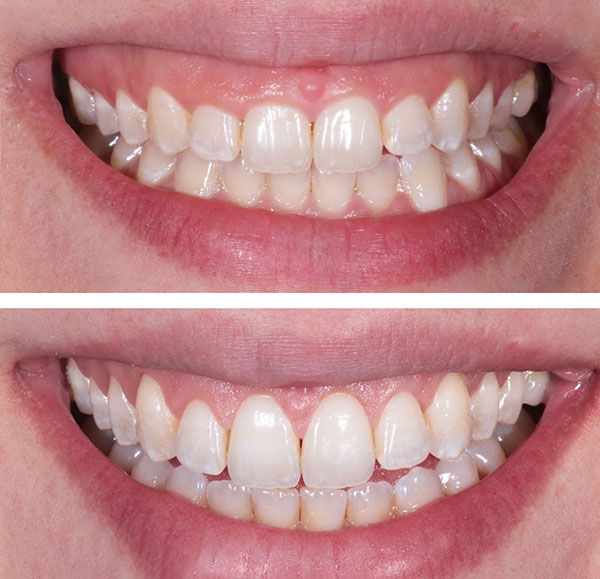 اصلاح طرح لبخند جراحی با افزایش طول تاج دندان